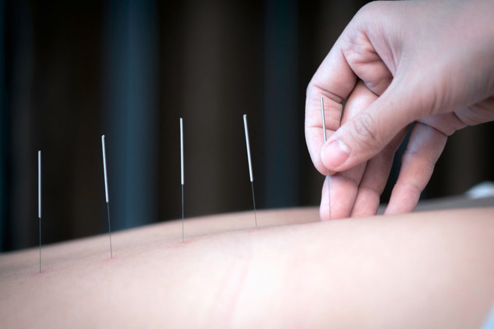 acupuncture for kids طب سوزنی کودکان