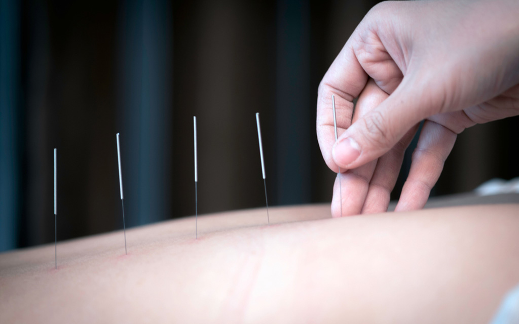 acupuncture for kids طب سوزنی کودکان
