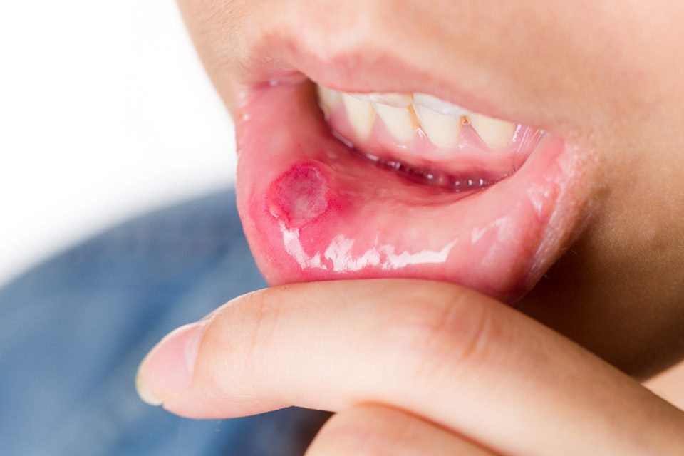 mouth sores treatment درمان آفت دهاتی