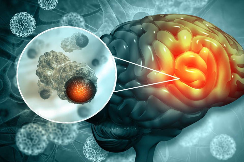 brain tumor treatment درمان تومور مغزی