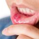 mouth sores treatment درمان آفت دهاتی