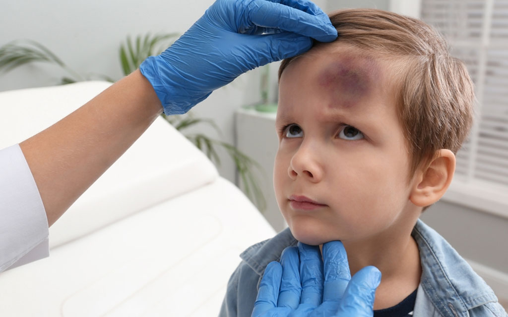 bruises treatment درمان کبودی و ضرب دیدگی