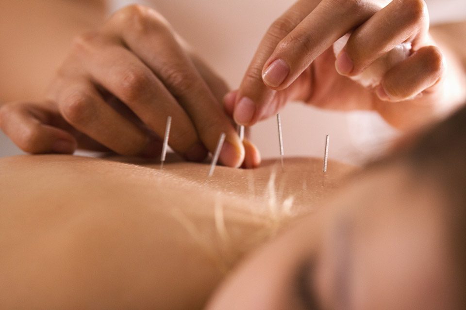 acupuncture benefits for everyone مزایای طب سوزنی برای همه