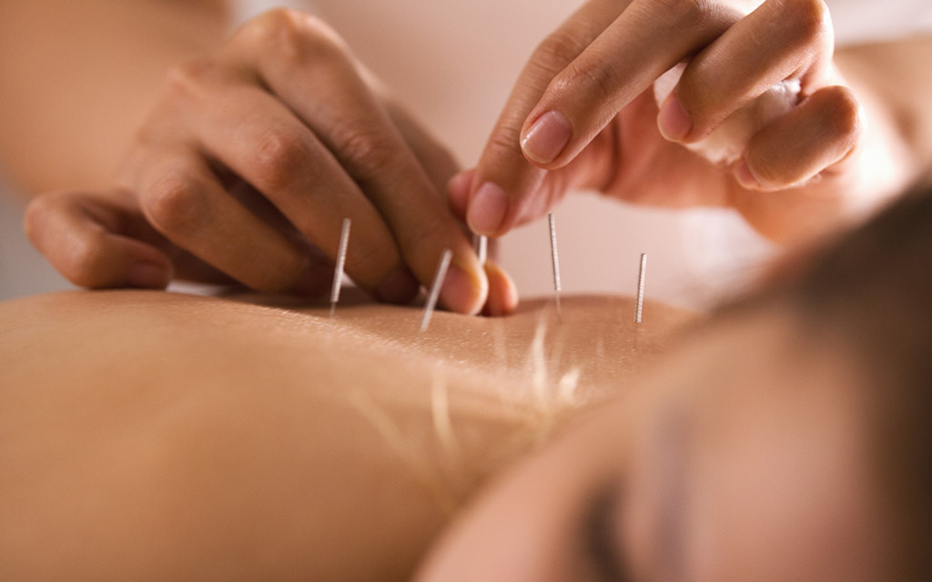 acupuncture benefits for everyone مزایای طب سوزنی برای همه