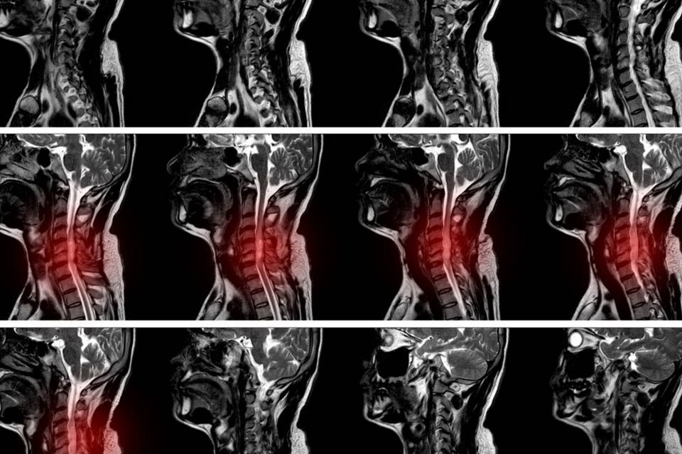 Cervical spinal canal stenosis تنگی کانال نخاعی گردن