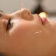 acupuncture-for-allergy-treatment